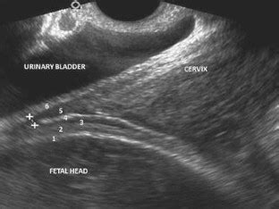 how to measure scar thickness on ultrasound|ultrasound for cesarean scars.